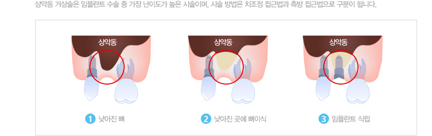 대전상악동 거상술 수술방법
