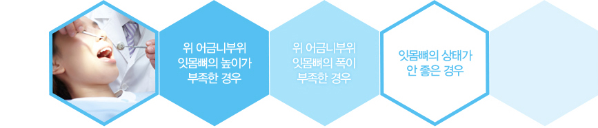 대전상악동 거상술이 필요한 경우
