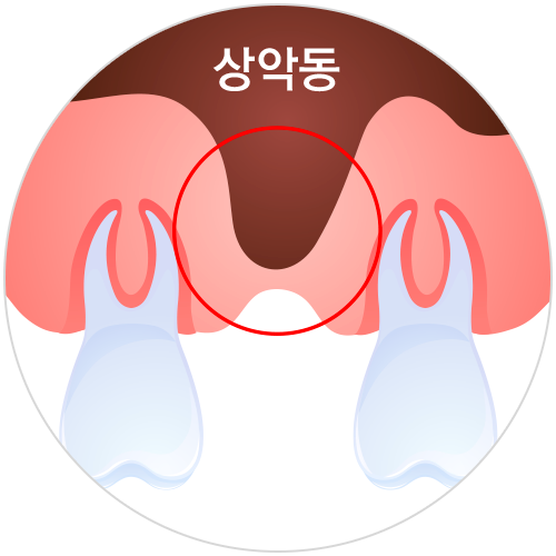 상악동거상술
