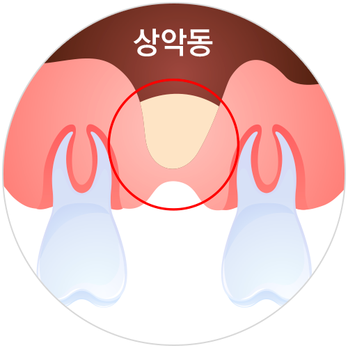 상악동거상술