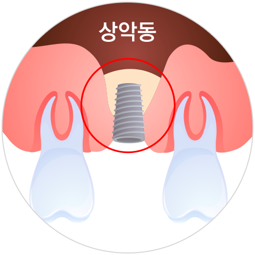 상악동거상술