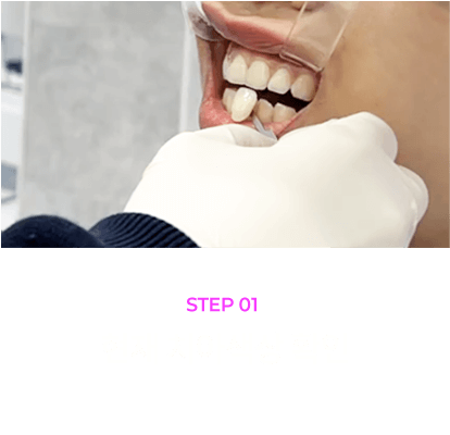 대전치아미백 과정: 1.현재 치아색상 확인