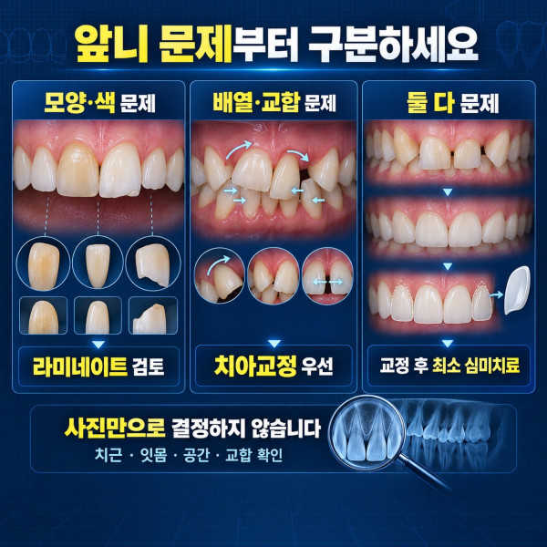 앞니 모양과 색 문제 배열과 교합 문제를 구분해 라미네이트 치아교정 병행 치료를 선택하는 기준