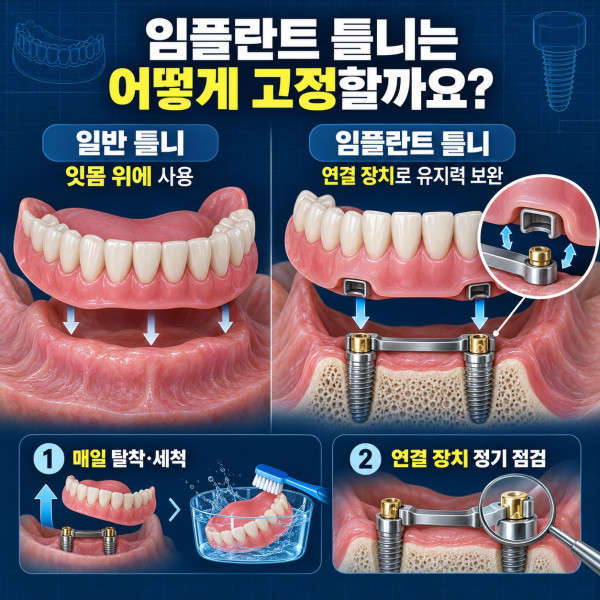 임플란트 틀니의 연결 구조와 일반 틀니보다 유지력을 보완하는 방식 안내