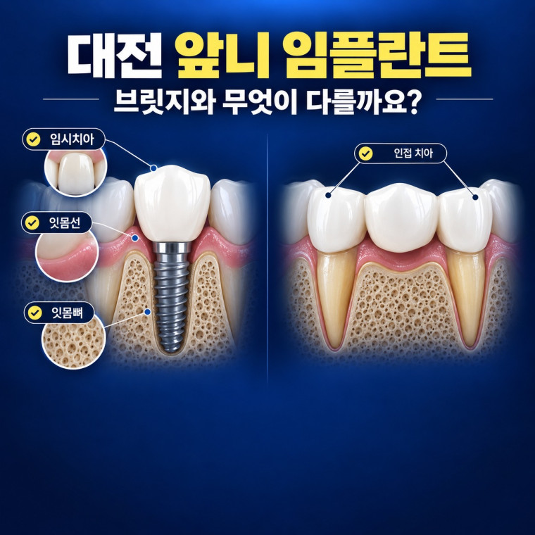 대전 앞니 임플란트 상담에서 임플란트와 브릿지를 비교하는 잇몸선 잇몸뼈 인접치아 기준