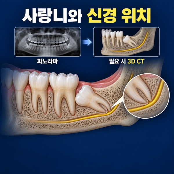 아래 사랑니 뿌리와 신경관 위치를 파노라마와 3D CT로 확인하는 개념도