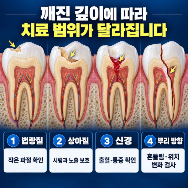 깨진 앞니의 법랑질 상아질 신경 노출 여부에 따른 검사와 치료 범위 안내