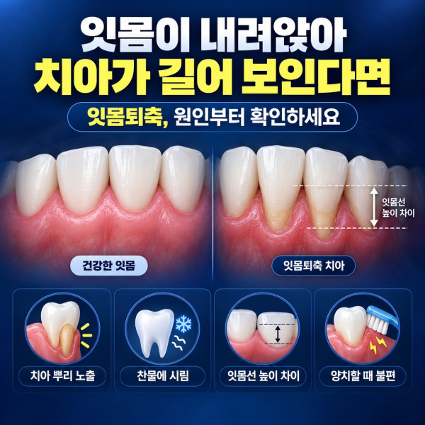 대전 잇몸이식 상담 전 잇몸퇴축으로 치아 뿌리가 노출되고 시린 증상 확인 안내