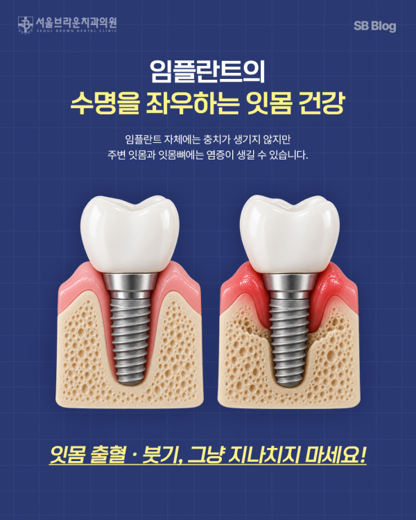 건강한 임플란트 잇몸과 임플란트 주위염 비교