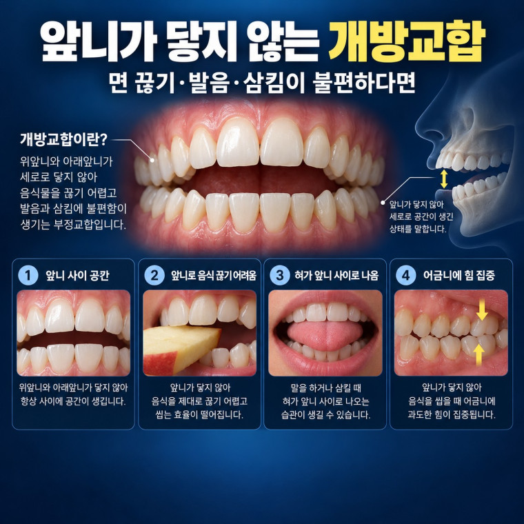 대전 개방교합 교정 상담 전 앞니가 닿지 않아 면을 끊기 어려운 증상과 확인 기준