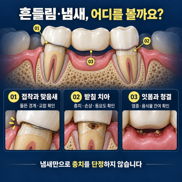 흔들리는 치아 브릿지의 접착과 맞음새 받침 치아 잇몸 청결을 확인하는 세 가지 검사 지점