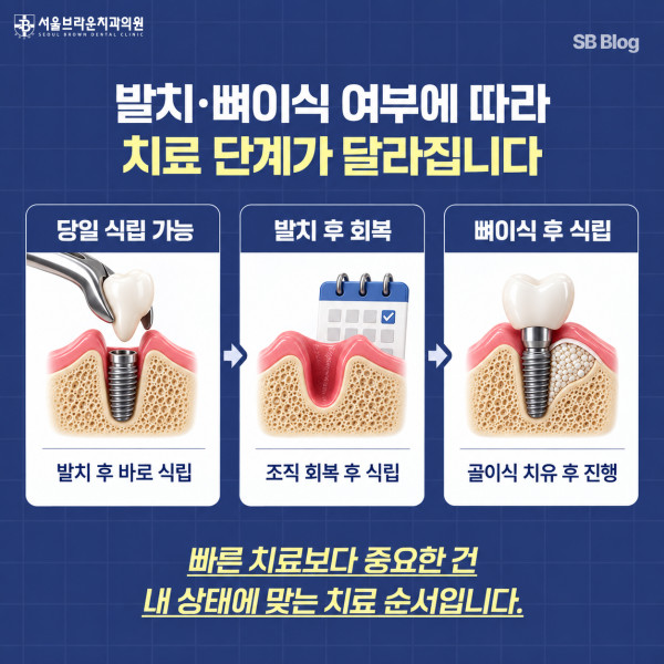 발치와 뼈이식 여부에 따라 달라지는 대전 임플란트 치료 단계