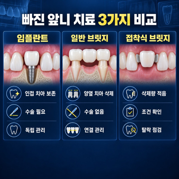 빠진 앞니 치료에서 임플란트 브릿지 접착식 브릿지의 치아 삭제 수술 기간 관리 비교