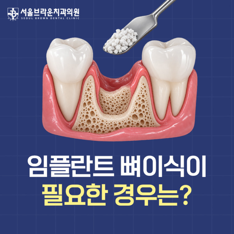 대전 임플란트 뼈이식이 필요한 경우와 진단 기준 안내