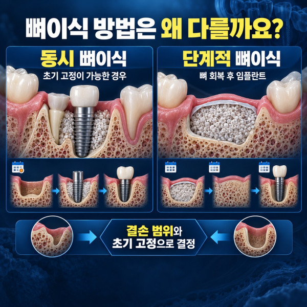 치아를 오래전에 뺀 뒤 잇몸뼈가 줄었을 때 동시 뼈이식과 단계적 임플란트 비교