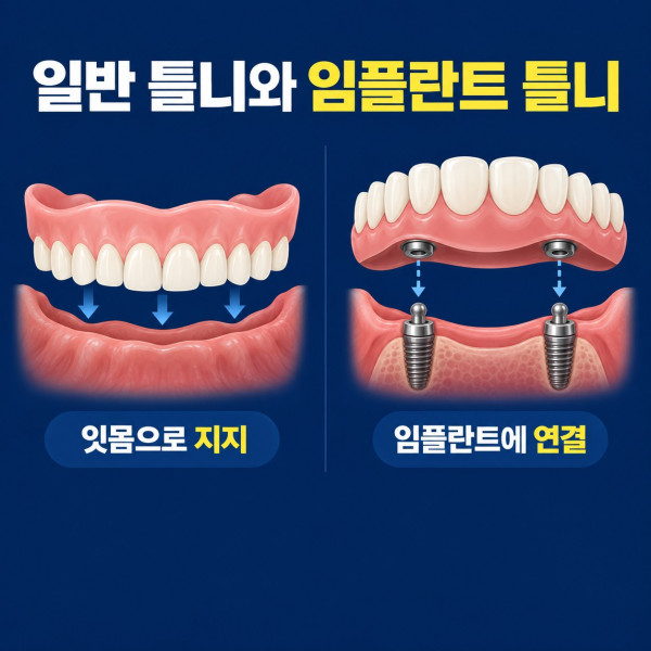 일반 틀니의 잇몸 지지 방식과 임플란트 틀니의 부착장치 연결 방식 비교