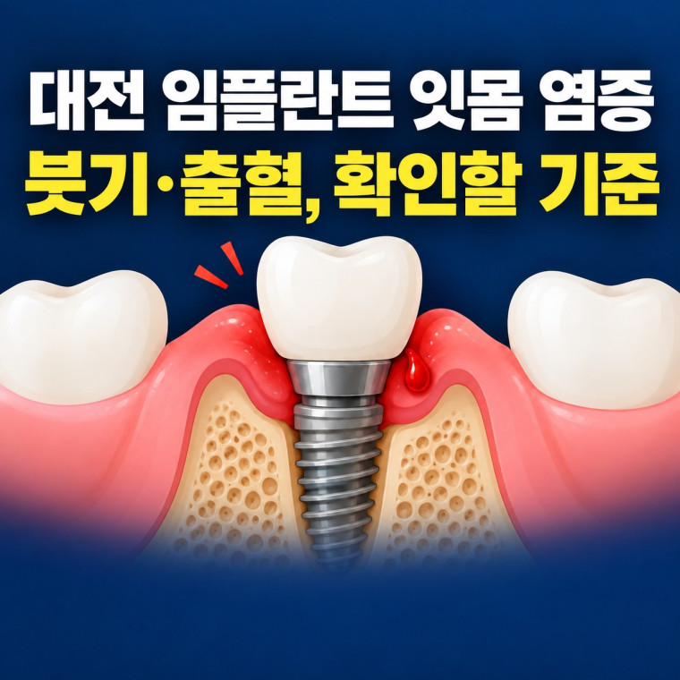 대전 임플란트 잇몸 염증 의심 시 붓기와 출혈 확인 기준