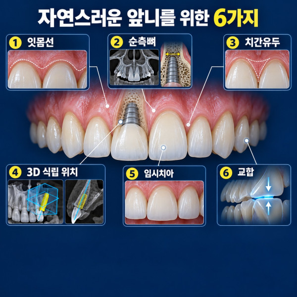 앞니 임플란트의 자연스러운 결과를 위한 잇몸선 순측뼈 치간유두 교합 임시치아 체크리스트