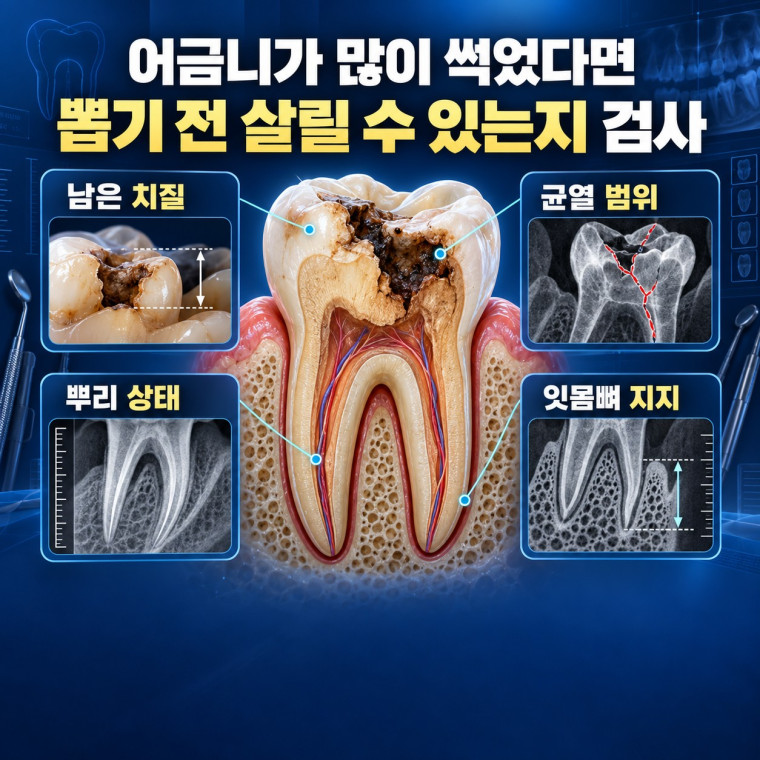 대전 어금니 보존치료 전 많이 썩은 치아의 남은 치질 균열 뿌리와 잇몸뼈를 검사하는 기준