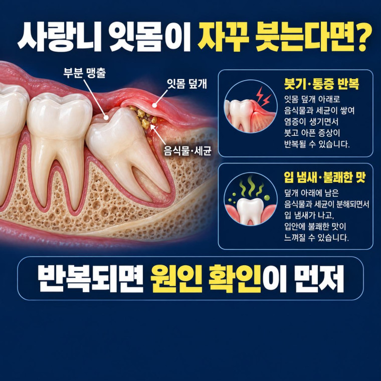 사랑니 일부가 잇몸에 덮여 음식물이 끼고 붓기와 통증이 반복되는 치관주위염 개념도