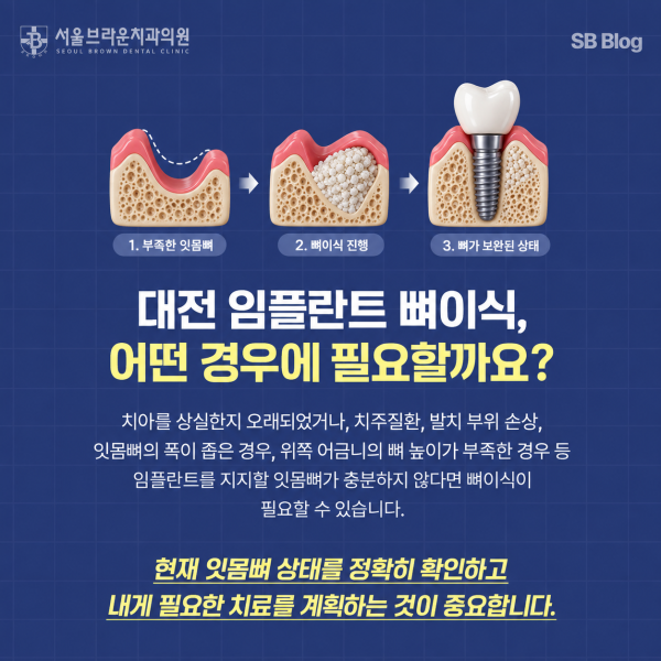 대전 임플란트 뼈이식으로 부족한 잇몸뼈를 보완하는 과정