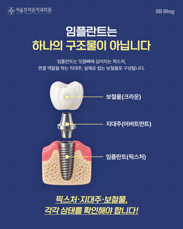 임플란트 픽스처 지대주 보철물 구조