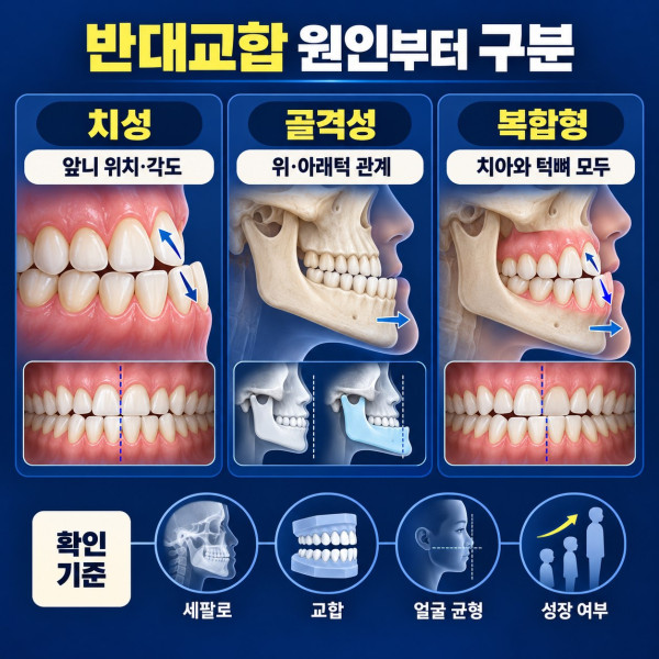 치아 위치가 원인인 치성 반대교합과 턱뼈 관계가 원인인 골격성 주걱턱 비교