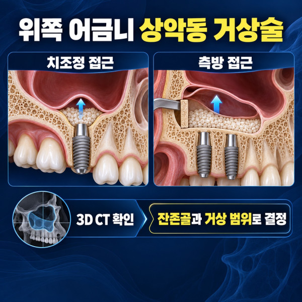 위쪽 어금니 임플란트에서 치조정 접근과 측방 접근 상악동 거상술 비교 안내