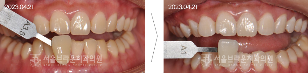 치아미백 전후사진