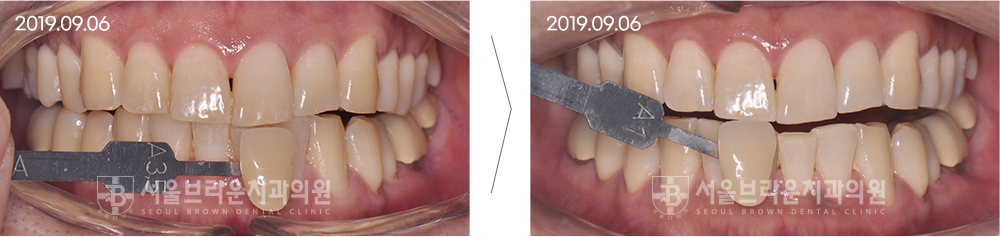 치아미백 전후사진