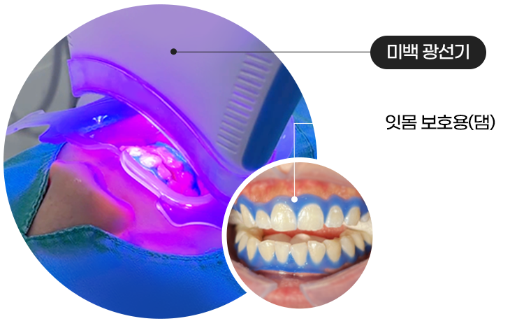 대전치아미백 서울브라운치과