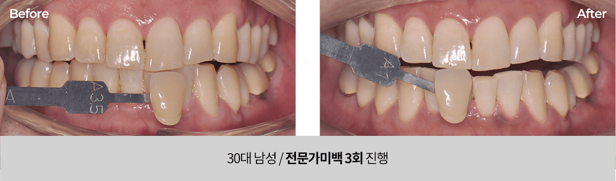 치아미백 전후사진.30대남성 전문가미백 3회 진행