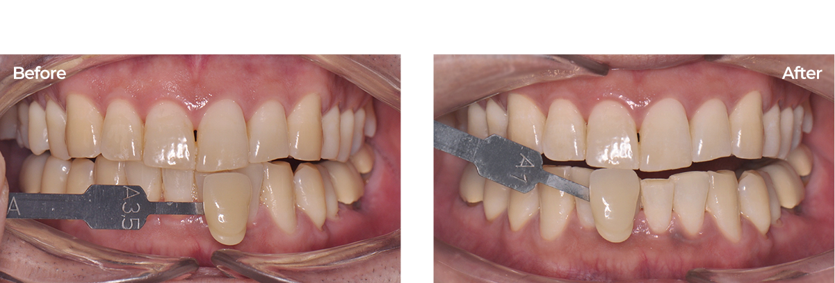 치아미백 전후사진.30대남성 전문가미백 3회 진행