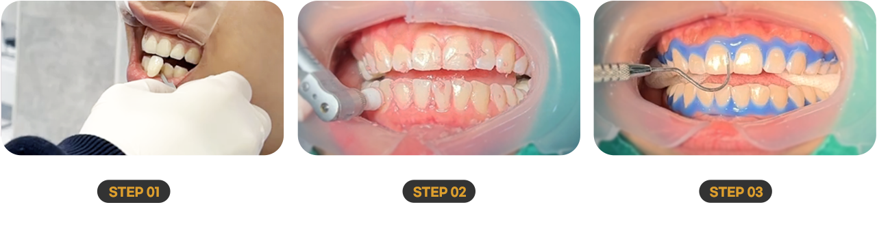 1.현재 치아색상 확인 2.치아표면 청소 3.잇몸보호용 댐 사용