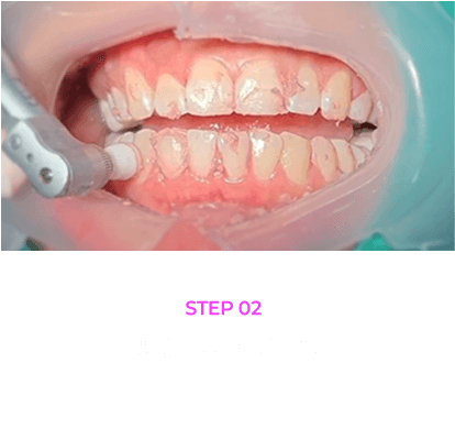 대전치아미백 과정: 2.치아표면 청소