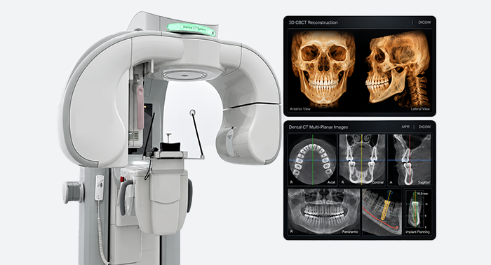 내비게이션 임플란트 3D CT 진단